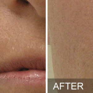 Où trouver un centre spécialisé en Hydrafacial à Villefranche ?