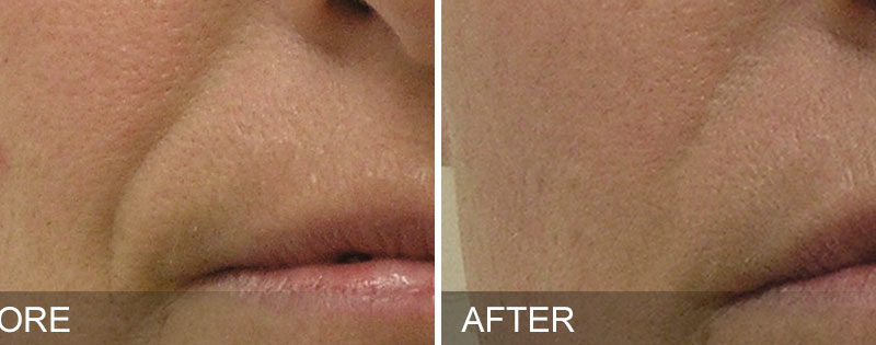 Où trouver un centre spécialisé en Hydrafacial à Villefranche ?