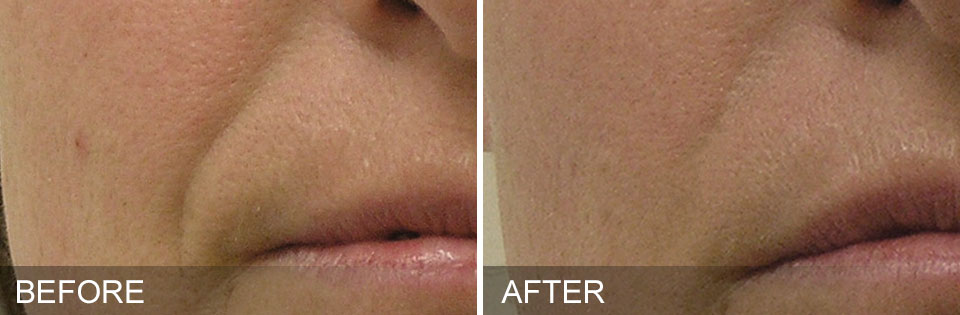 Où trouver un centre spécialisé en Hydrafacial à Villefranche ?