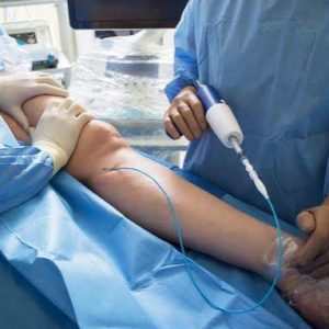 Comment savoir si je suis un bon candidat pour un traitement Laser varices ?
