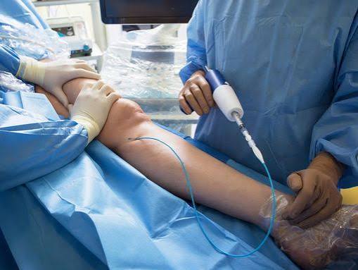 Comment savoir si je suis un bon candidat pour un traitement Laser varices ?